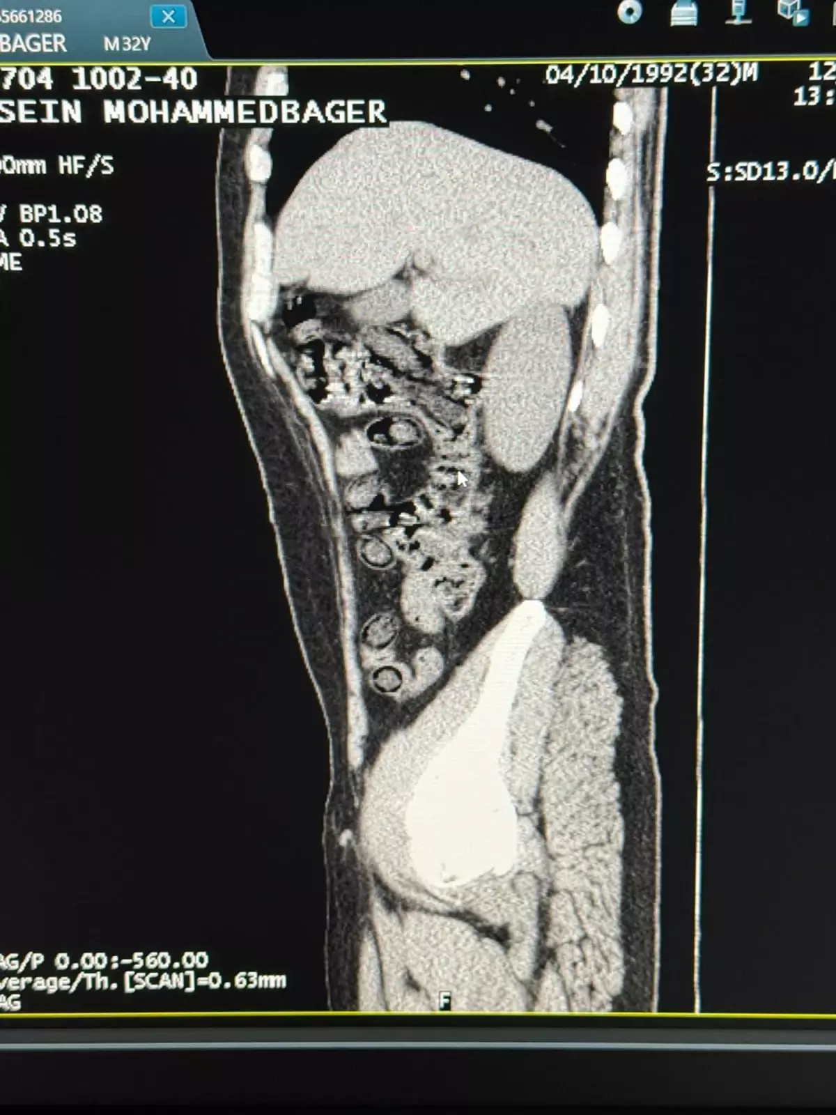 Muş’ta İki İran Uyruklu Şahsın Midesinden 928 Gram Metamfetamin Çıkarıldı